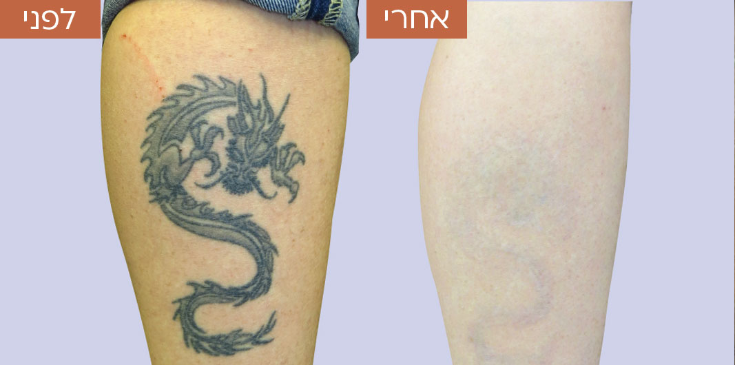 לפני-ואחרי-הסרת-קעקועים-2