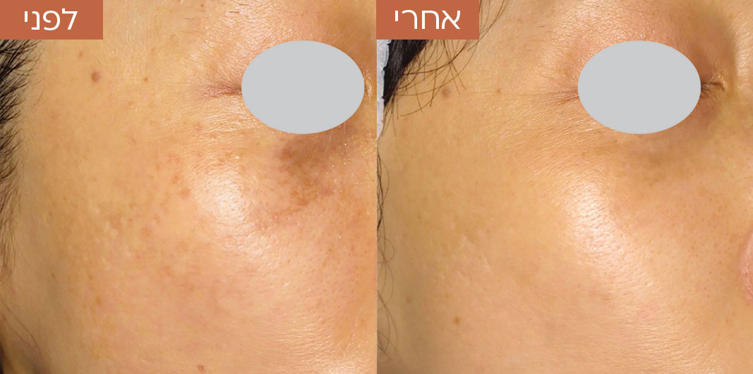 Pigmentation_before_and_after_1-1_1