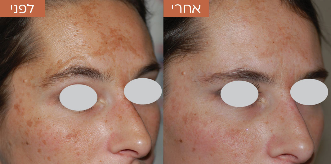 Pigmentation_before_and_after_2-1_1