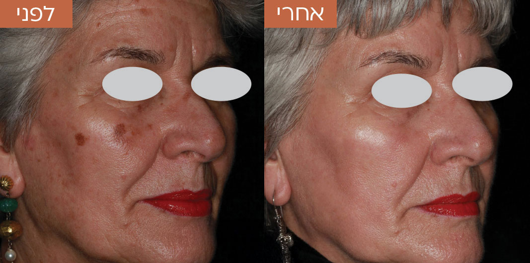 Pigmentation_before_and_after_3-1_1