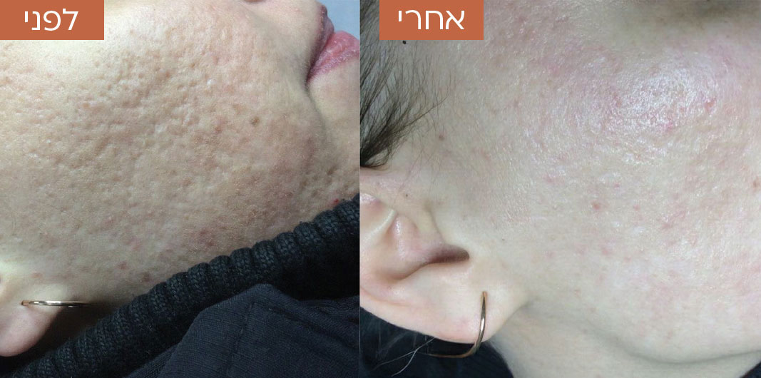 טיפול-באקנה-ובפוסט-אקנה-1_1