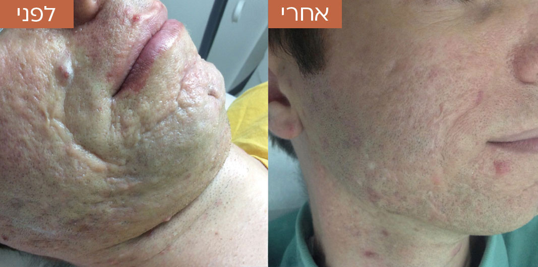 טיפול-באקנה-ובפוסט-אקנה-3.jpg_1