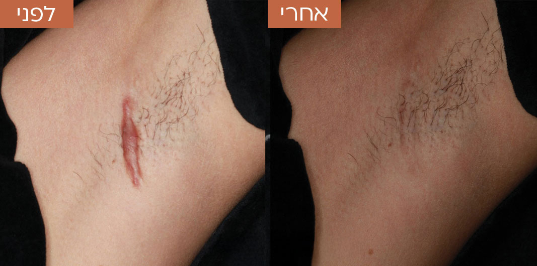 טשטוש-צלקות-לפני-ואחרי-1.jpg_1
