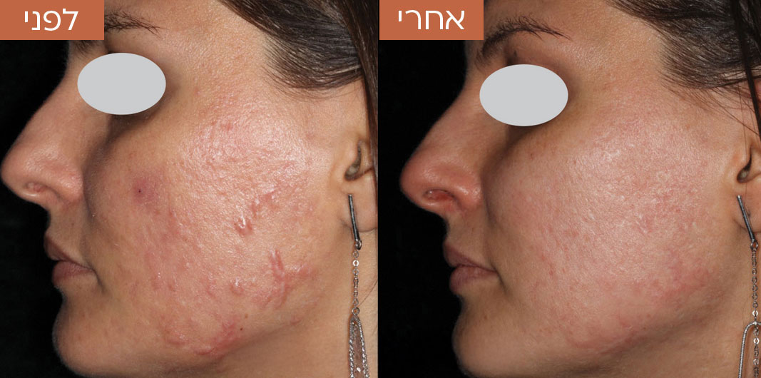 טשטוש-צלקות-לפני-ואחרי-2.jpg_1