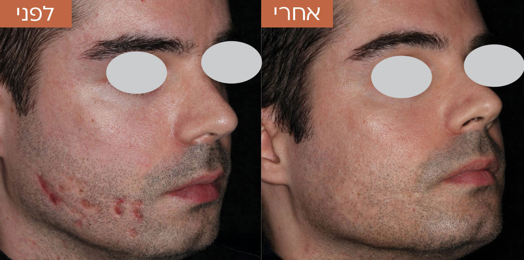 טשטוש-צלקות-לפני-ואחרי-3.jpg_1