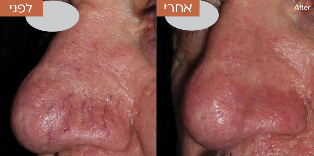 טשטוש-צלקות-לפני-ואחרי-4.jpg_1