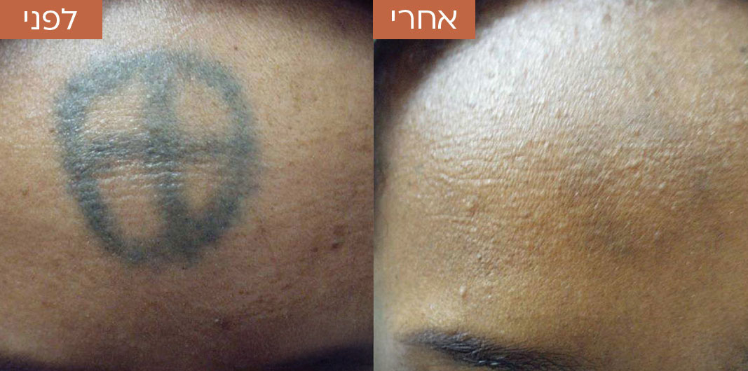 לפני-ואחרי-הסרת-קעקועים.jpg_1