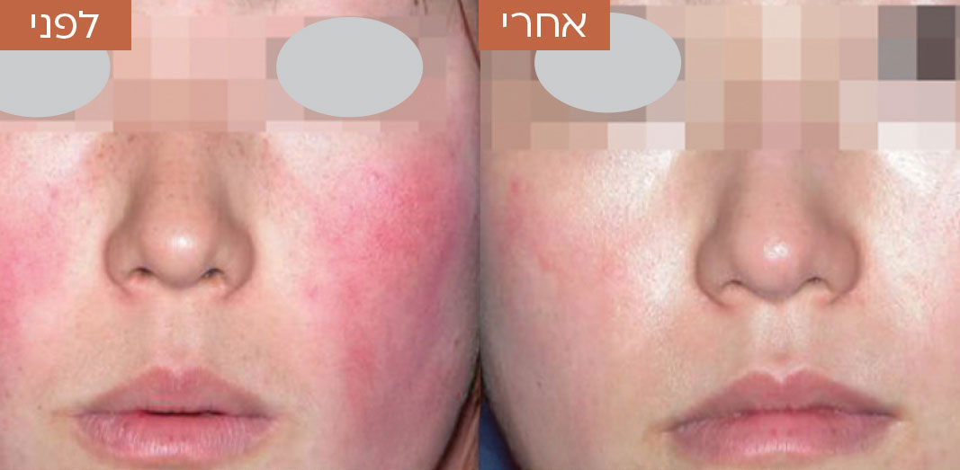 לפני-ואחרי-טשטוש-כלי-דם-1.jpg_1