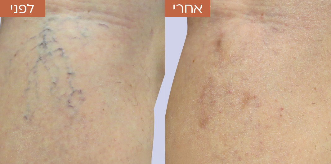 לפני-ואחרי-טשטוש-כלי-דם-2.jpg_1
