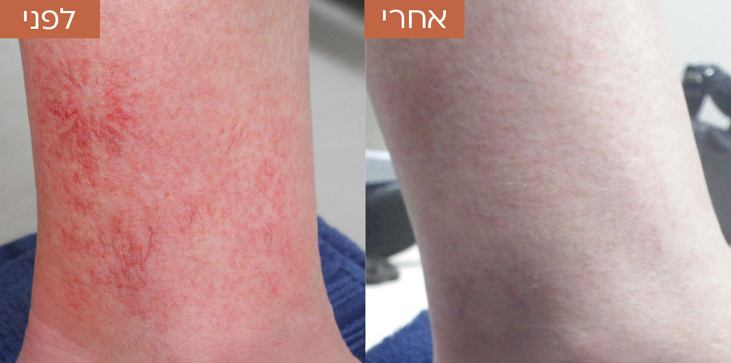 לפני-ואחרי-טשטוש-כלי-דם-3.jpg_1