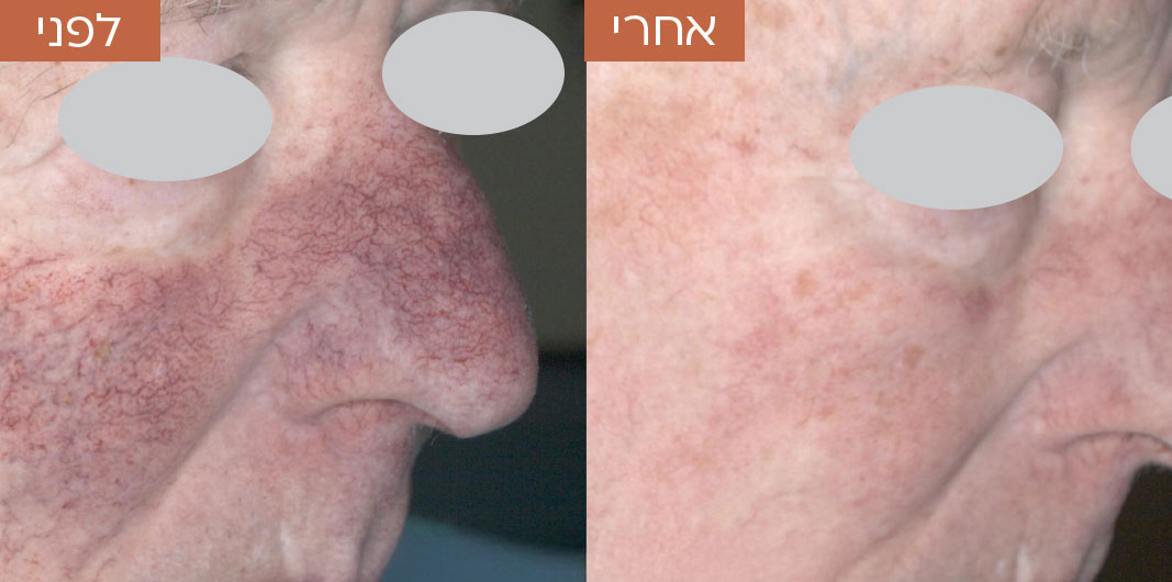 לפני-ואחרי-טשטוש-כלי-דם-5.jpg_1