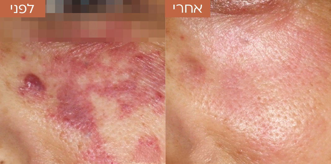 לפני-ואחרי-טשטוש-כלי-דם-6.jpg_1