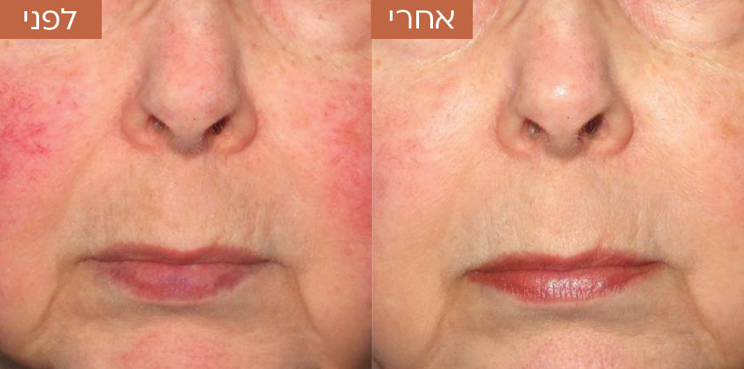 לפני-ואחרי-טשטוש-כלי-דם-7.jpg_1
