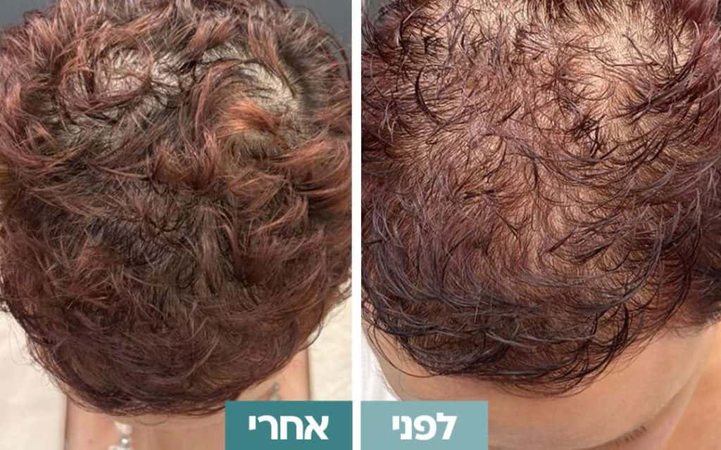 לפני ואחרי טיפול PRP לשיער